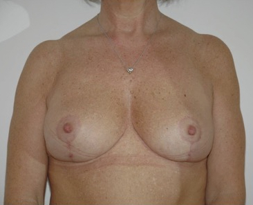 Breast Reduction After Result 3
