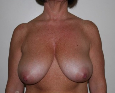 Breast Reduction Before Result 3